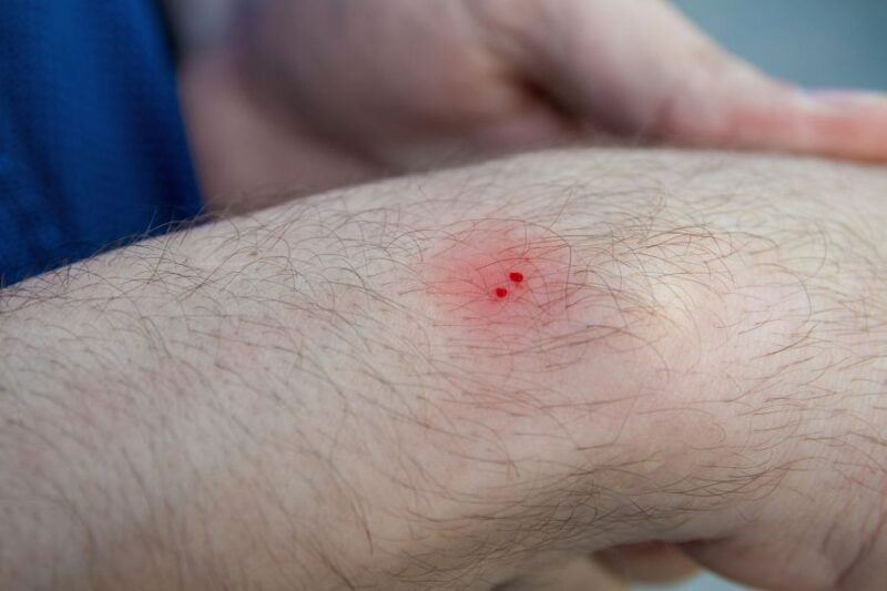 What to Do if Bitten by a Snake